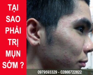 tại-sao-phải-trị-mụn-sớm---bạch-hoa-hồng---0979593329