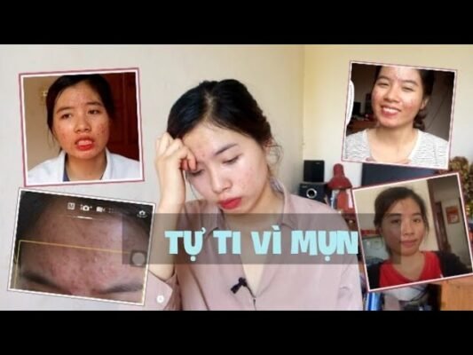 thuốc trị mụn Bạch Hoa Hồng