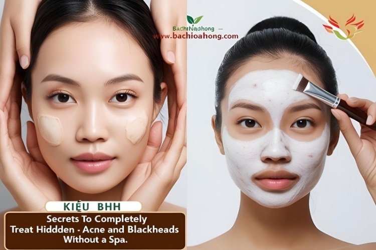 Bạch Hoa Hồng Chia Sẻ Bí Quyết Trị Mụn Ẩn, Mụn Đầu Đen Tận Gốc Không Cần Spa